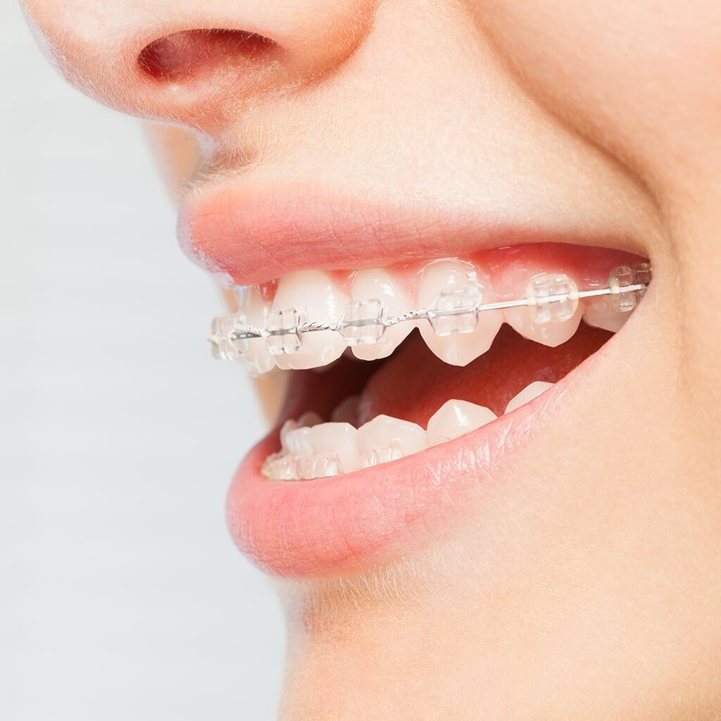 How Rubber Bands For Braces Help Align Your Teeth During Treatment